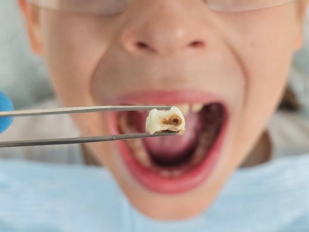 Best Emergency Root Canal Treatment in Granville South, OH